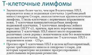 Все про Т клеточную лимфому