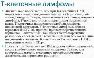 Все про Т клеточную лимфому
