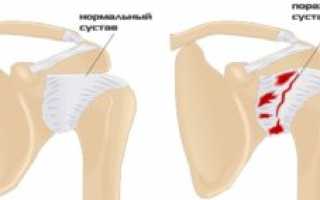 Артроз плечевого сустава: что за болезнь? Симптомы, причины, лечение