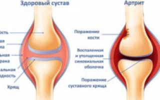 Артрит: что это? Причины, симптомы, лечение, профилактика