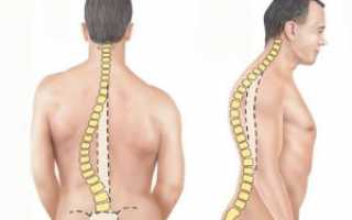Сколиоз поясничного отдела позвоночника: что это такое? Симптомы и лечение