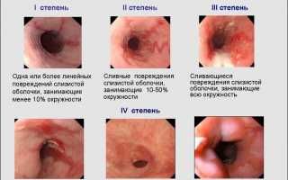 Характерные симптомы рефлюкс-эзофагита и способы лечения