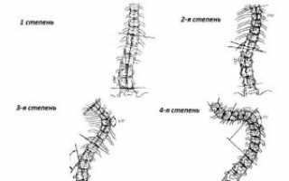 Сколиоз: что это такое? Причины искривления, симптомы и лечение