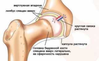 Вывих бедра: виды, причины, симптоматика, диагностика, лечение