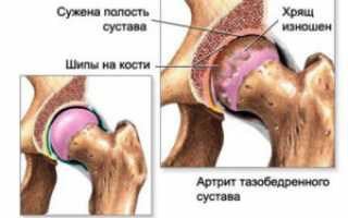 Лечение тазобедренного сустава в домашних условиях: медикаменты и народные средства