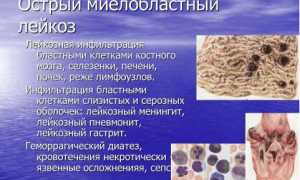 Все самое важное про острый миелобластный лейкоз
