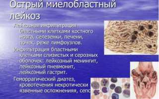 Все самое важное про острый миелобластный лейкоз
