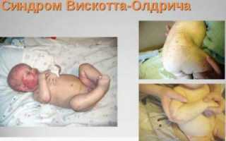 Вся информация про синдром Вискотта-Олдрича