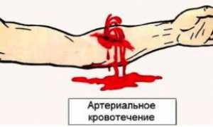 Инструкции по наложению жгута при артериальном кровотечении