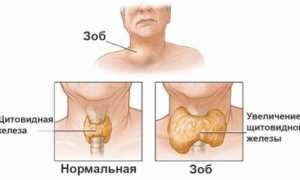 Узнаем все про повышенный тиреоглобулин