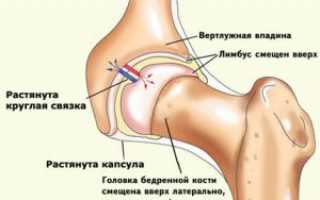 Дисплазия тазобедренного сустава: симптомы, причины, диагностика, лечение