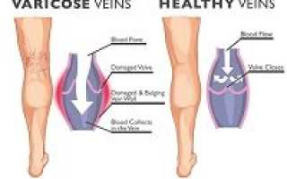 Можно ли вылечить варикоз без операции