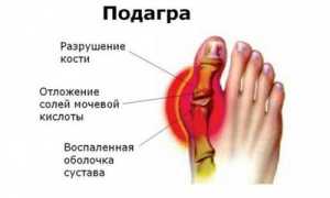 Обзор препаратов для выведения мочевой кислоты при подагре
