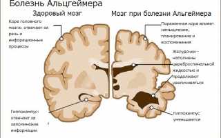 Особенности лечения болезни Альцгеймера