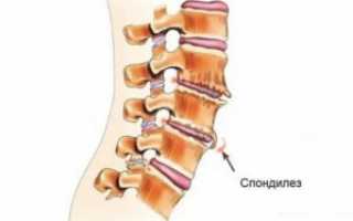 Спондилез – почему возникает? Симптомы, диагностика, лечение