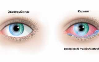 2 одинаково опасные разновидности вирусного кератита. Как не допустить развития болезни?