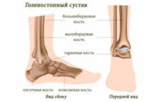 Боль в голеностопном суставе: причины, симптомы, диагностика, лечение