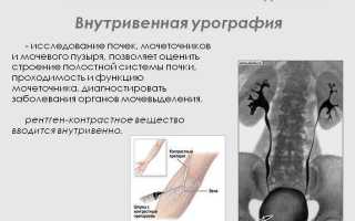 Основные признаки и методы лечения синдрома Фрейли