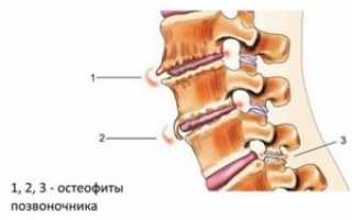 Остеофиты: причины, симптомы, диагностика, лечение