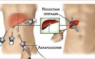 Методы борьбы с холецистокардиальным синдромом