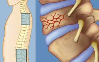 Компрессионный перелом позвоночника: причины, лечение, профилактика