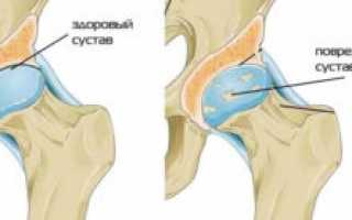 Коксартроз 2 степени: причины, симптомы, диагностика, лечение