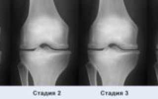 Остеоартроз коленного сустава 1 степени – как лечить и предупредить