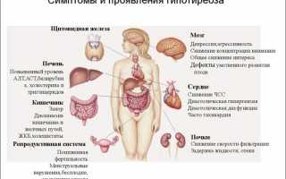 Причины развития и методы лечения синдрома гипотиреоза