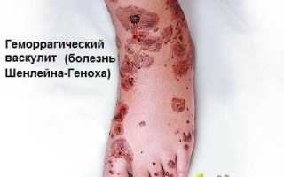 Вся информация про геморрагический васкулит