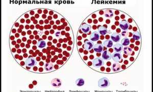 Разбираем анализ крови при лейкозе