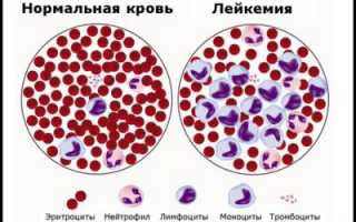 Разбираем анализ крови при лейкозе