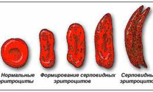 Все про серповидноклеточную анемию