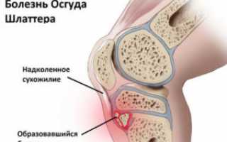 Болезнь Шляттера: причины, симптомы, диагностика и лечение