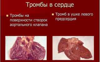 Подробно о тромбах в сердце