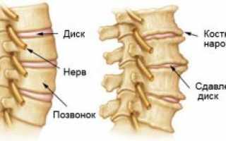 Остеоартроз позвоночника: причины, симптоматика, лечение