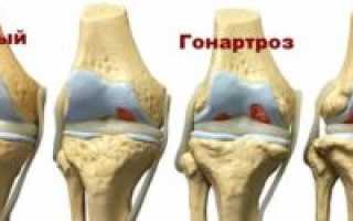 Гонартроз: диагностика, профилактика и лечение недуга