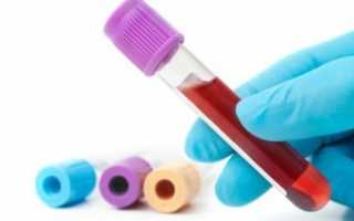 Все про атипичные мононуклеары в анализе крови, каковы причины их появления?