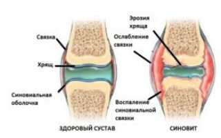 Синовит: причины, симптомы, лечение, профилактика недуга