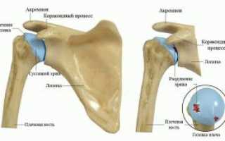 Остеоартроз плечевого сустава – как проявляется? Стадии, лечение, профилактика