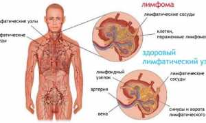 Все про анализ крови при лимфоме Ходжкина
