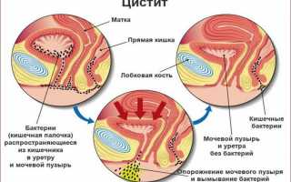 Причины синдрома раздраженного мочевого пузыря и лечение патологии