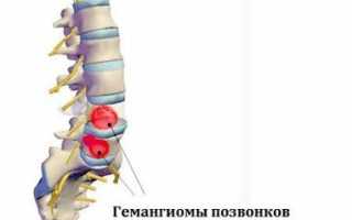 Вся информация про гемангиому позвоночника