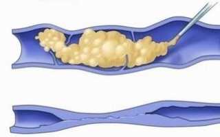 Уколы от варикоза