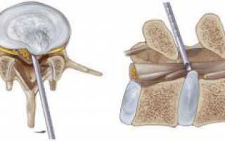 Удаление грыжи позвоночника: способы, осложнения, реабилитация