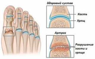 Деформирующий артроз стопы: особенности, симптомы, причины, лечение
