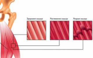 Растяжение мышц – причины, симптомы, лечение, профилактика