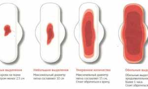 Разберемся, как уменьшить обильные месячные