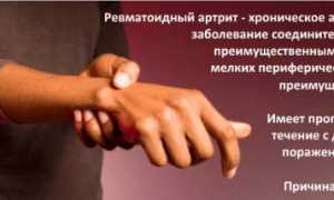 Узнаем нормы ревматоидного фактора