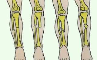 Перелом большеберцовой кости: что это такое? Симптомы и лечение