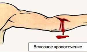 Как оказывать первую помощь при венозном кровотечении?